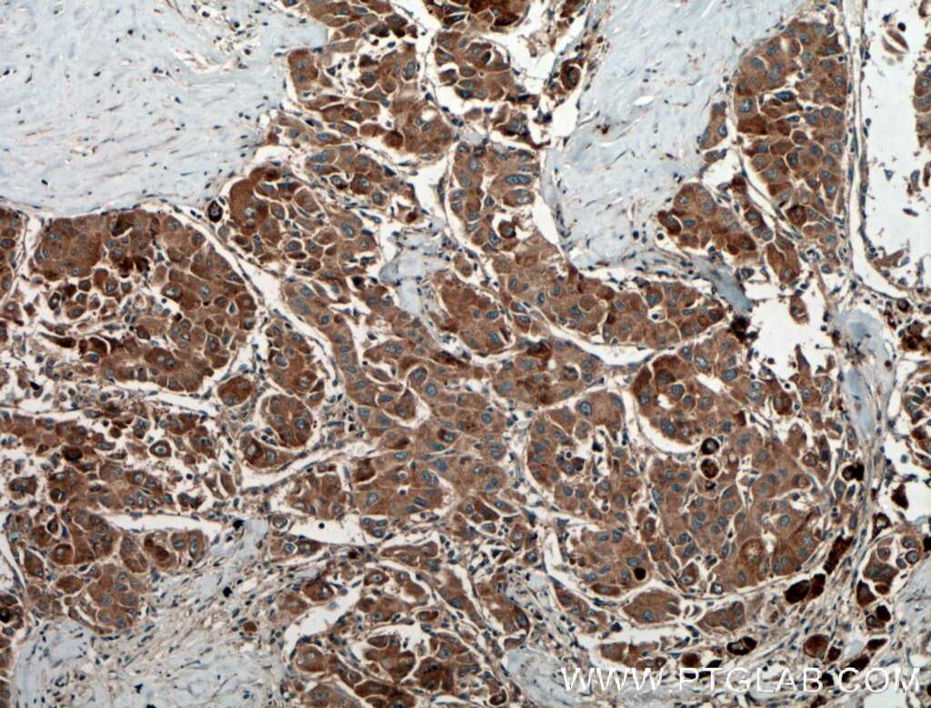 Immunohistochemistry (IHC) staining of human liver cancer tissue using AKD2 Polyclonal antibody (27554-1-AP)