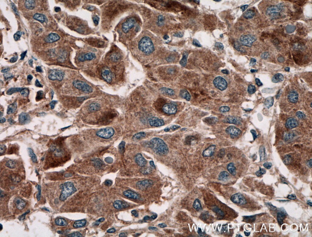 Immunohistochemistry (IHC) staining of human liver cancer tissue using AKD2 Polyclonal antibody (27554-1-AP)