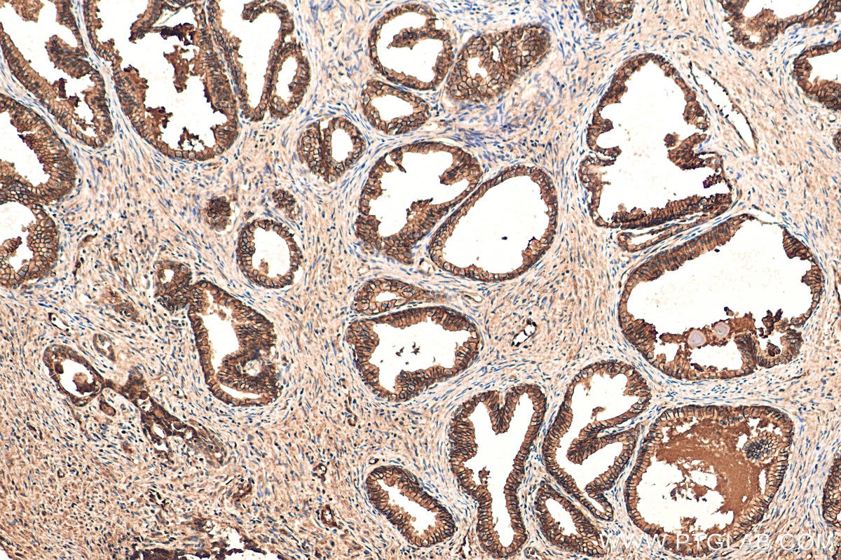 Immunohistochemistry (IHC) staining of human prostate cancer tissue using AKR1C3 Polyclonal antibody (11194-1-AP)