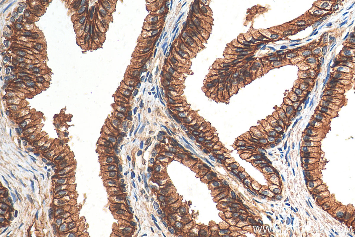 Immunohistochemistry (IHC) staining of human prostate cancer tissue using AKR1C3 Polyclonal antibody (11194-1-AP)