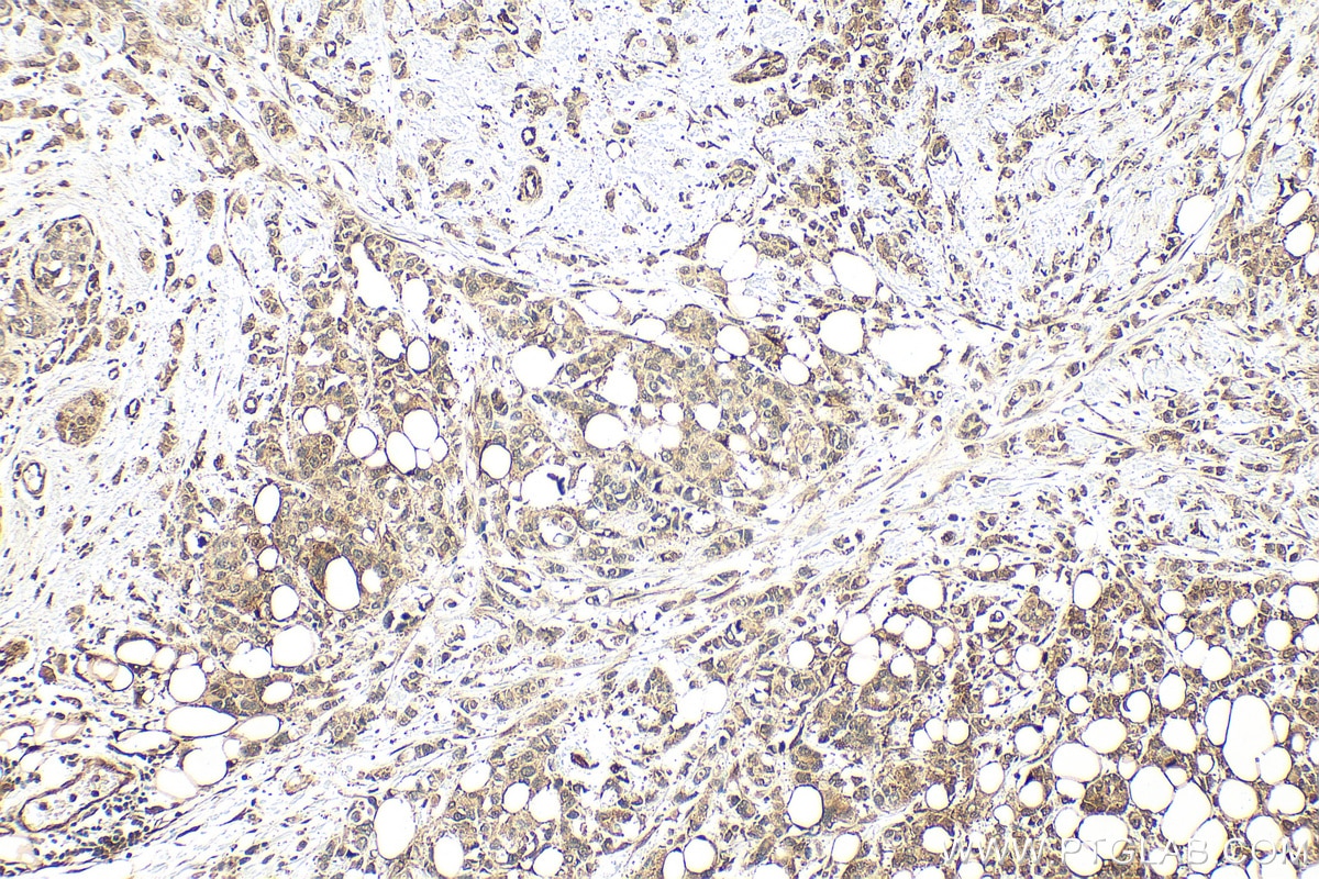 Immunohistochemistry (IHC) staining of human breast cancer tissue using Multi-rAb® AKR1C3 Multi-Recombinant antibody (RMX00069)