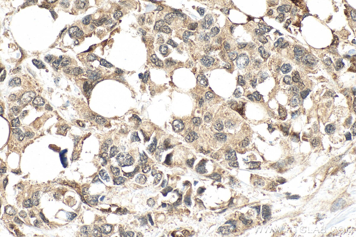 Immunohistochemistry (IHC) staining of human breast cancer tissue using Multi-rAb® AKR1C3 Multi-Recombinant antibody (RMX00069)