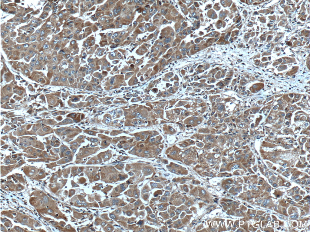 Immunohistochemistry (IHC) staining of human liver cancer tissue using AKR7A2 Polyclonal antibody (10730-1-AP)