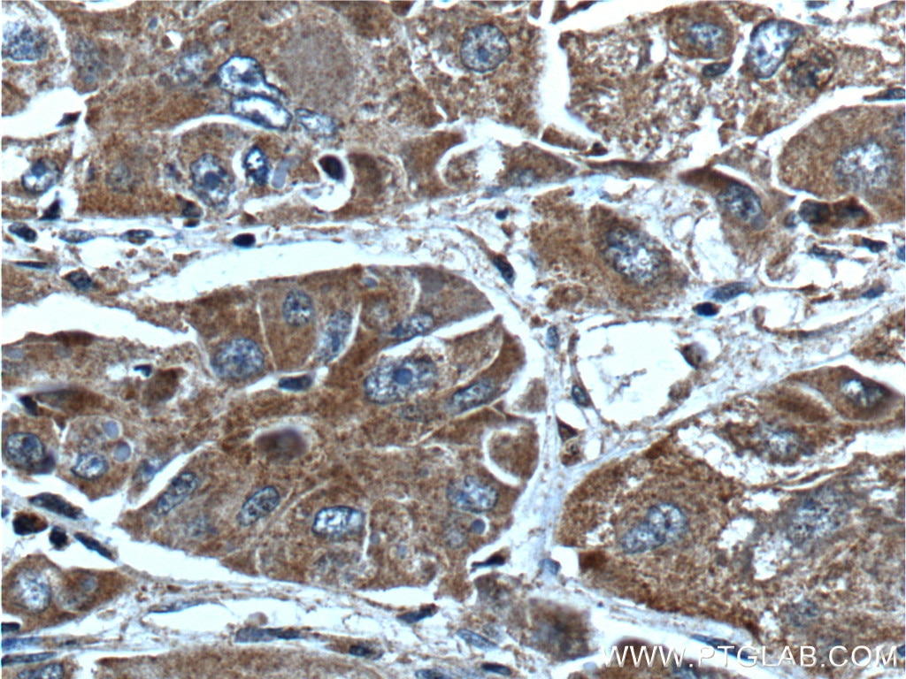 Immunohistochemistry (IHC) staining of human liver cancer tissue using AKR7A2 Polyclonal antibody (10730-1-AP)
