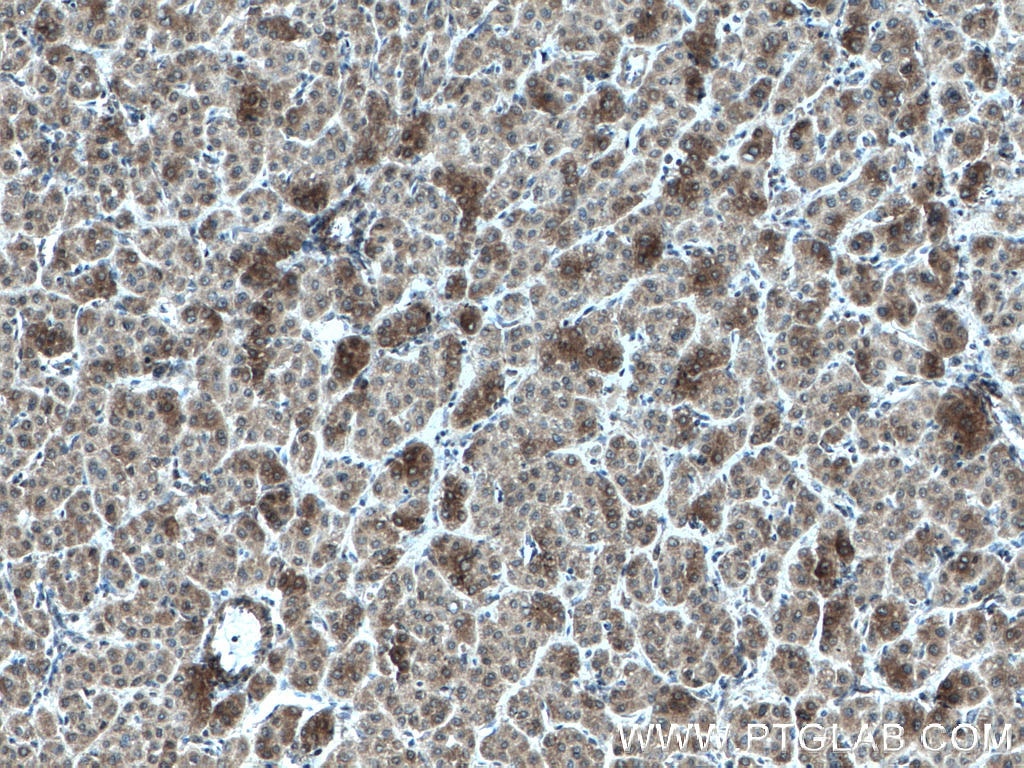 Immunohistochemistry (IHC) staining of human liver cancer tissue using AKR7A2 Monoclonal antibody (66677-1-Ig)