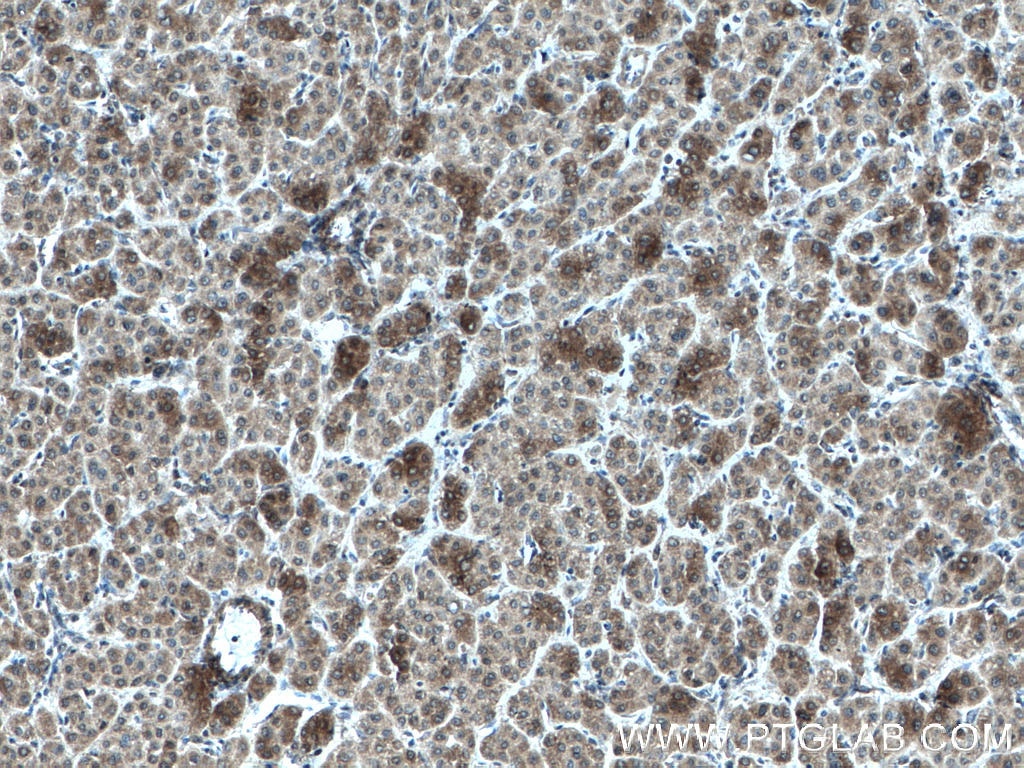 Immunohistochemistry (IHC) staining of human liver cancer tissue using AKR7A2 Monoclonal antibody (66677-1-Ig)