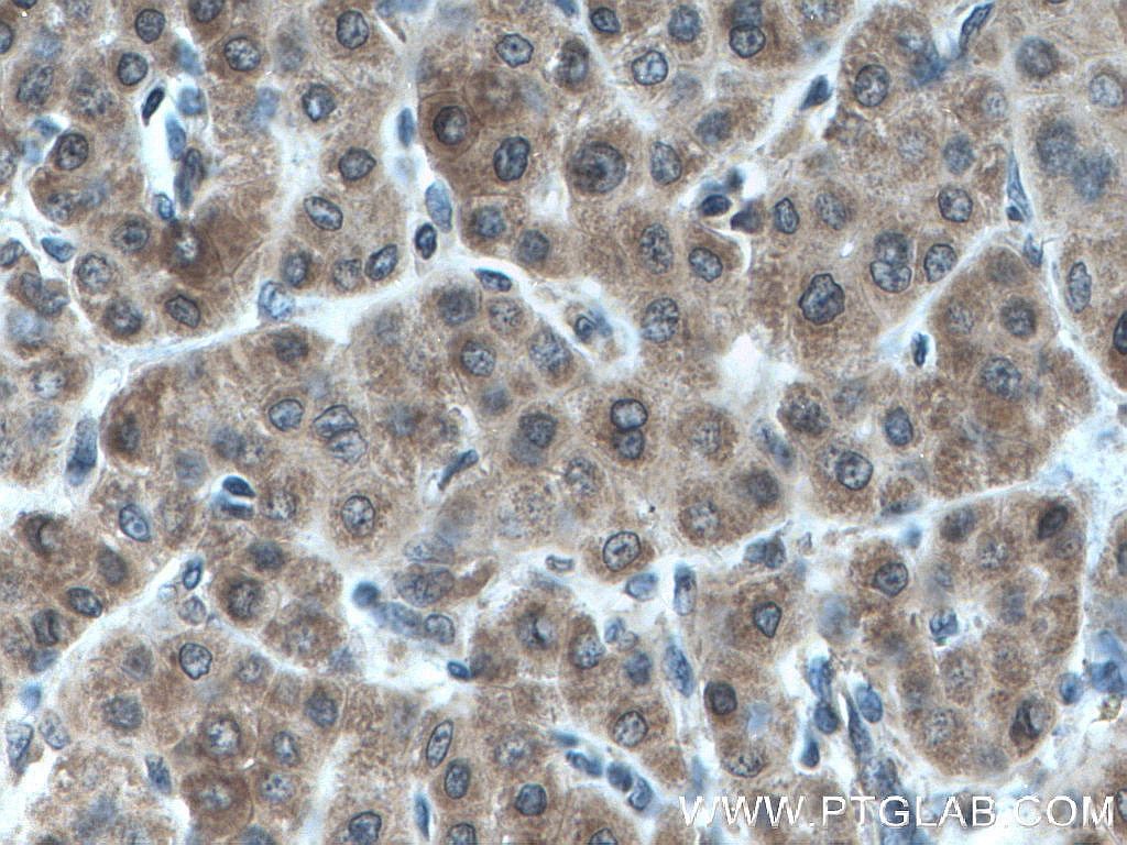 Immunohistochemistry (IHC) staining of human liver cancer tissue using AKR7A2 Monoclonal antibody (66677-1-Ig)