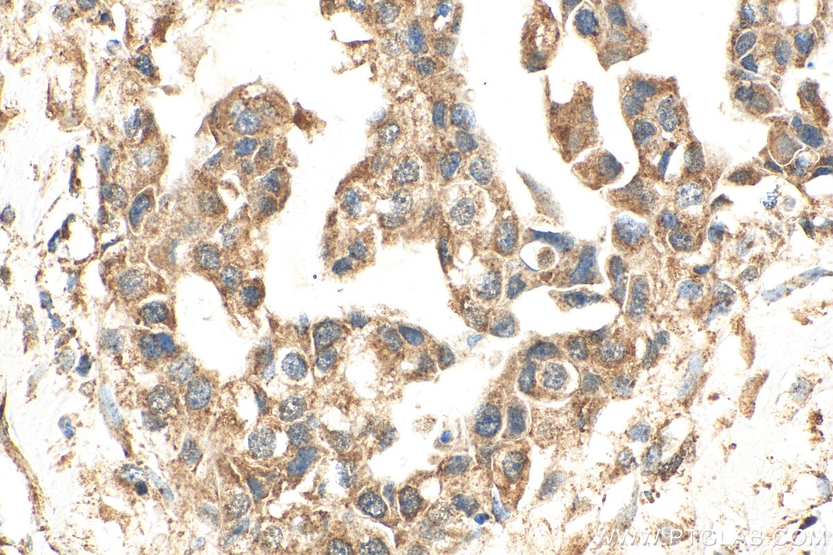 Immunohistochemistry (IHC) staining of human breast cancer tissue using AKT Polyclonal antibody (10176-2-AP)