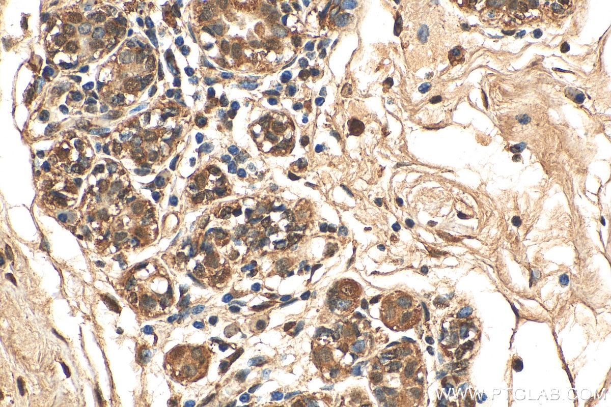 Immunohistochemistry (IHC) staining of human breast cancer tissue using AKT Polyclonal antibody (10176-2-AP)