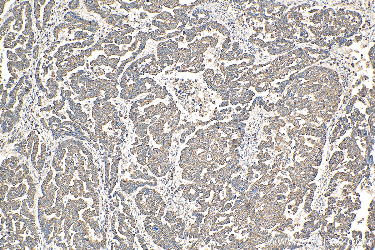 Immunohistochemistry (IHC) staining of human ovary tumor tissue using AKT Polyclonal antibody (10176-2-AP)