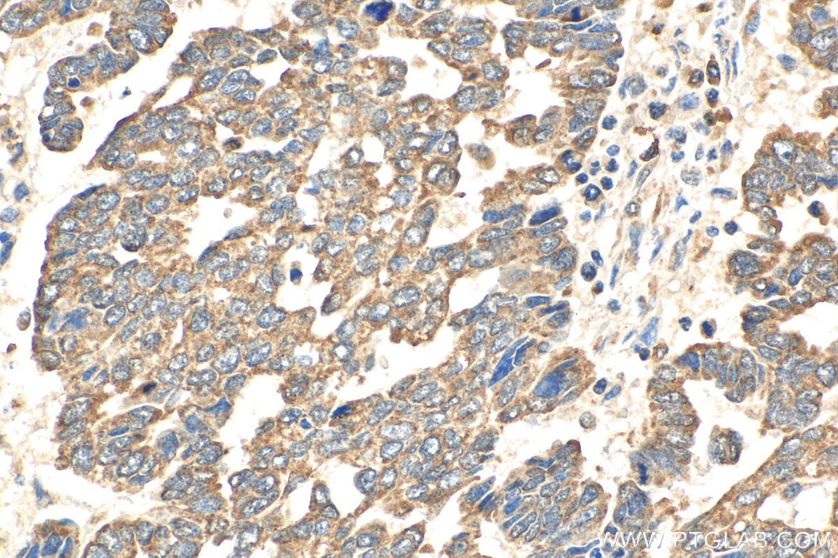 Immunohistochemistry (IHC) staining of human ovary tumor tissue using AKT Polyclonal antibody (10176-2-AP)