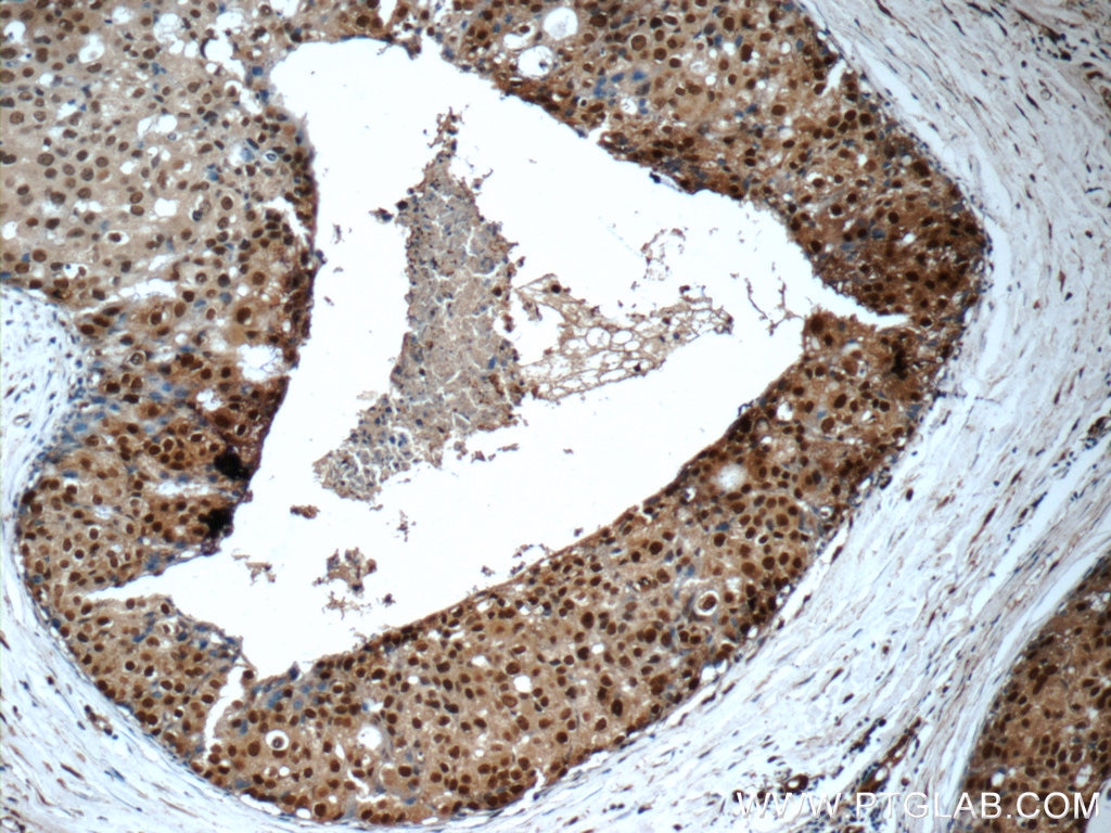 IHC staining of human breast cancer using 60203-1-Ig