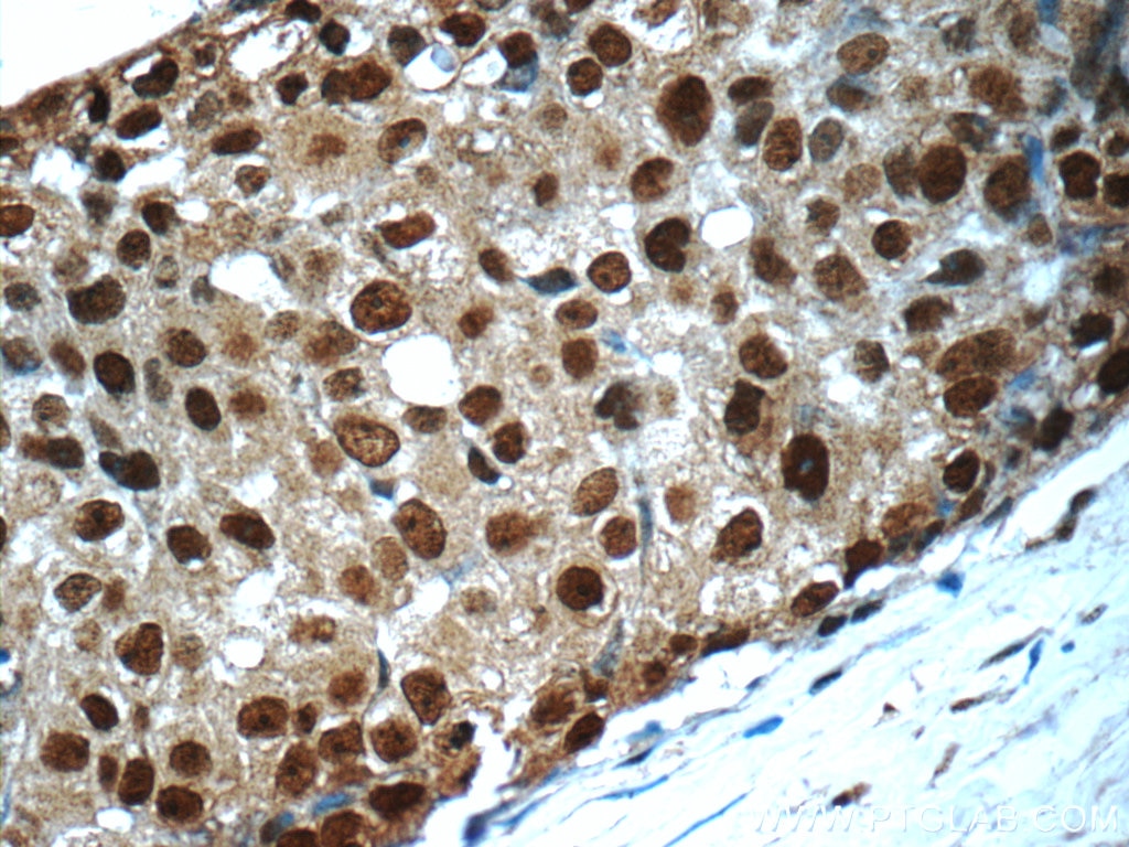 Immunohistochemistry (IHC) staining of human breast cancer tissue using AKT1/3 Monoclonal antibody (60203-1-Ig)