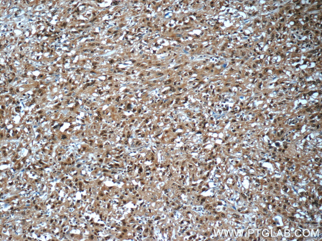 Immunohistochemistry (IHC) staining of human cervical cancer tissue using AKT1/3 Monoclonal antibody (60203-1-Ig)