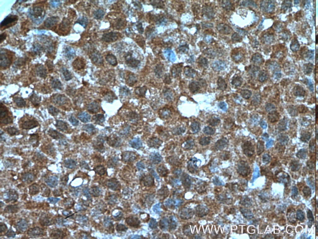 Immunohistochemistry (IHC) staining of human breast cancer tissue using AKT1/3 Monoclonal antibody (60203-1-Ig)