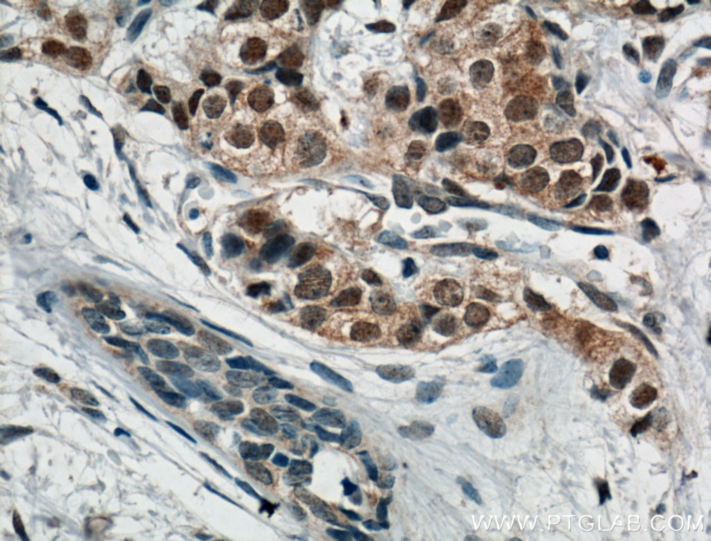 Immunohistochemistry (IHC) staining of human breast cancer tissue using AKT Monoclonal antibody (60203-2-Ig)