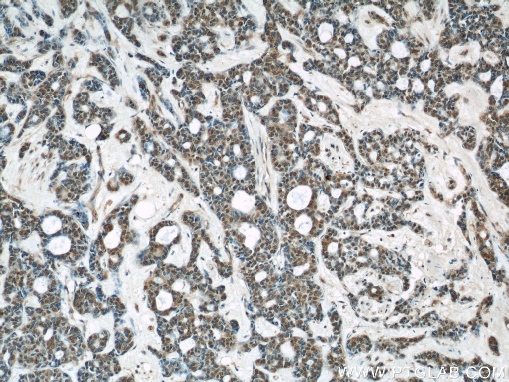 Immunohistochemistry (IHC) staining of human cervical cancer tissue using AKT Monoclonal antibody (60203-2-Ig)