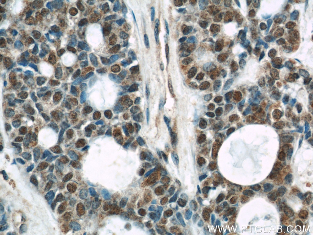 IHC staining of human cervical cancer using 60203-2-Ig