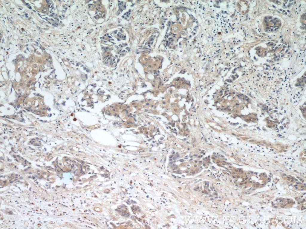 Immunohistochemistry (IHC) staining of human breast cancer tissue using AKT Monoclonal antibody (60203-2-Ig)