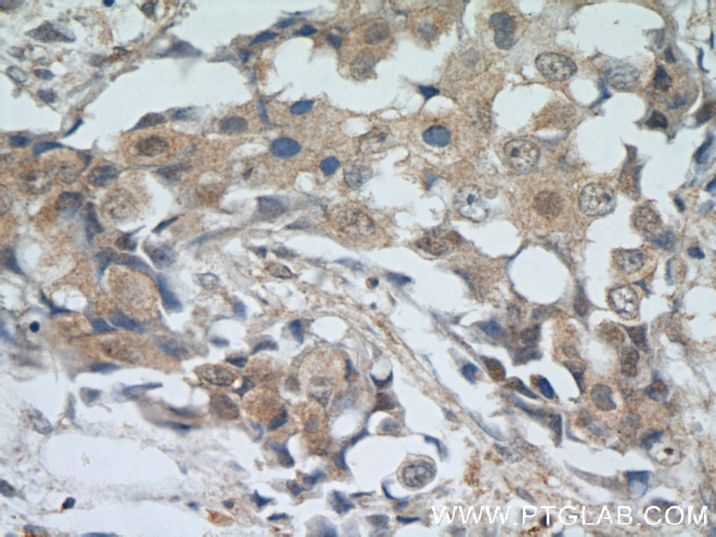 Immunohistochemistry (IHC) staining of human breast cancer tissue using AKT Monoclonal antibody (60203-2-Ig)