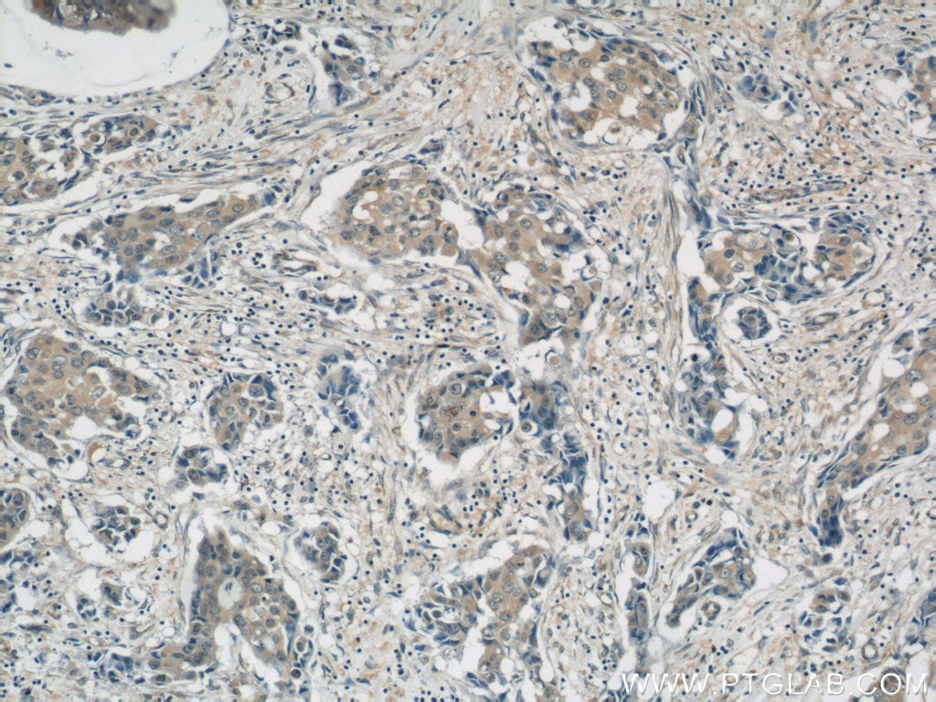 Immunohistochemistry (IHC) staining of human breast cancer tissue using AKT Monoclonal antibody (60203-2-Ig)