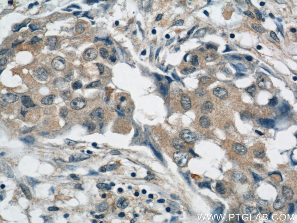 Immunohistochemistry (IHC) staining of human breast cancer tissue using AKT Monoclonal antibody (60203-2-Ig)