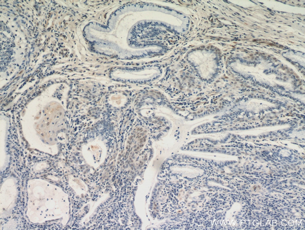Immunohistochemistry (IHC) staining of human cervical cancer tissue using AKT Polyclonal antibody (51077-1-AP)