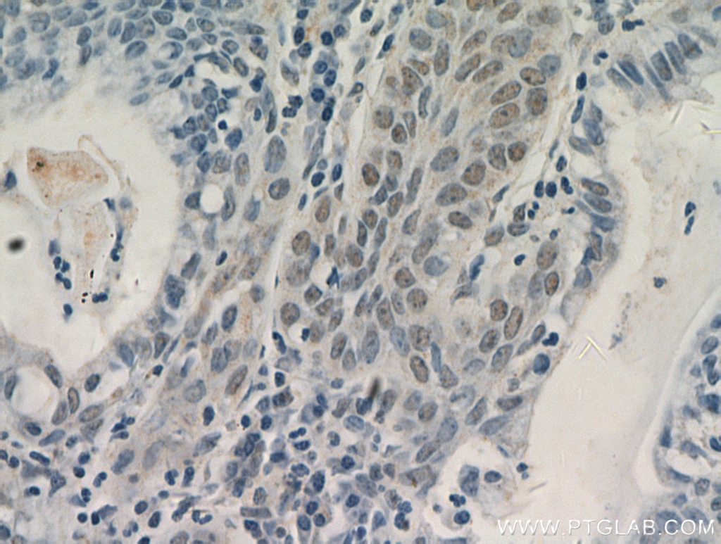 Immunohistochemistry (IHC) staining of human cervical cancer tissue using AKT Polyclonal antibody (51077-1-AP)