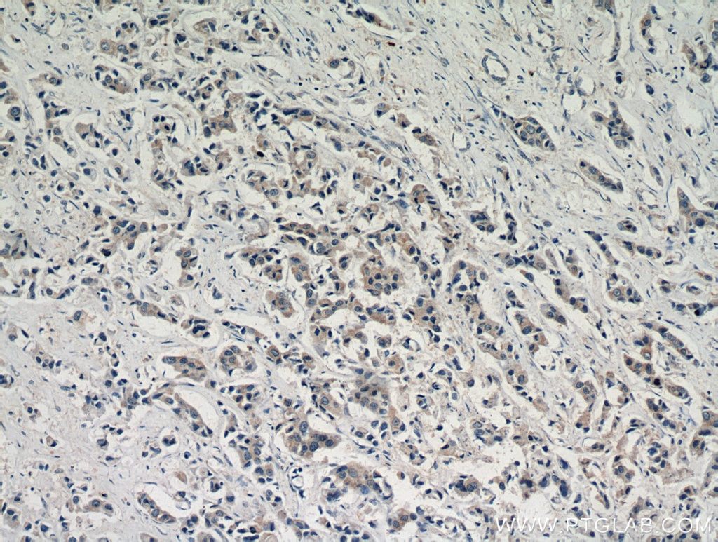 Immunohistochemistry (IHC) staining of human breast cancer tissue using AKT Polyclonal antibody (51077-1-AP)