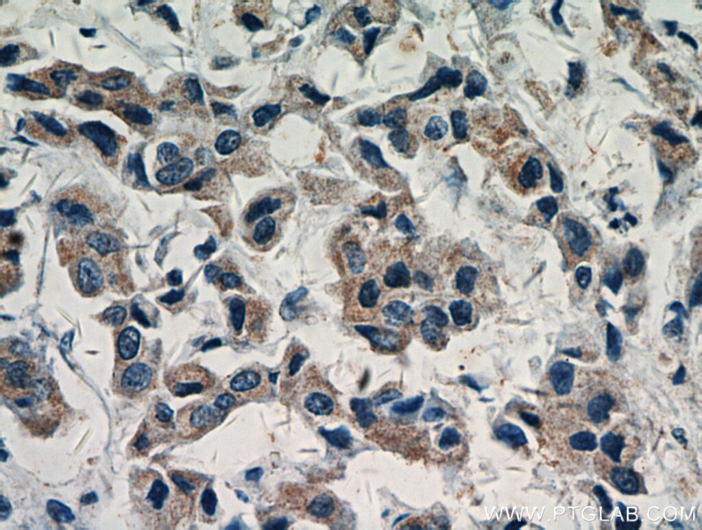 Immunohistochemistry (IHC) staining of human breast cancer tissue using AKT Polyclonal antibody (51077-1-AP)