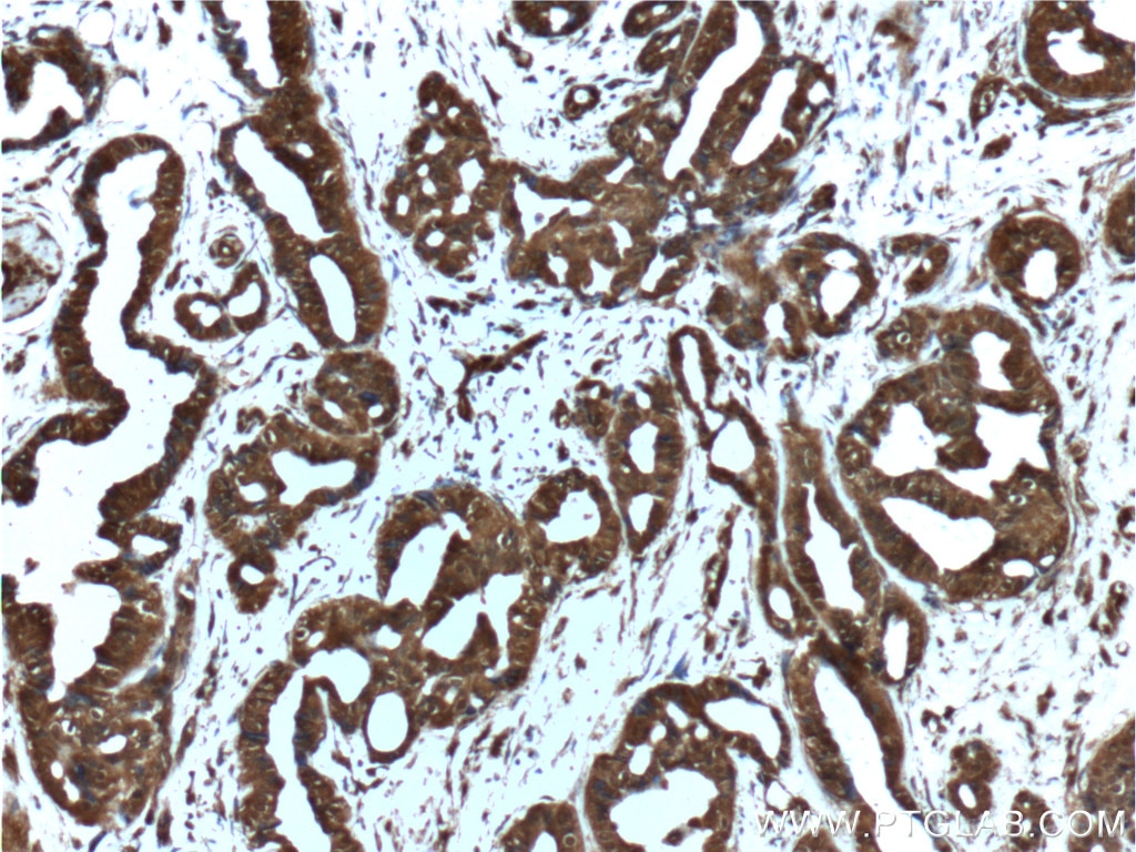 Immunohistochemistry (IHC) staining of human breast cancer tissue using AKT Polyclonal antibody (55230-1-AP)
