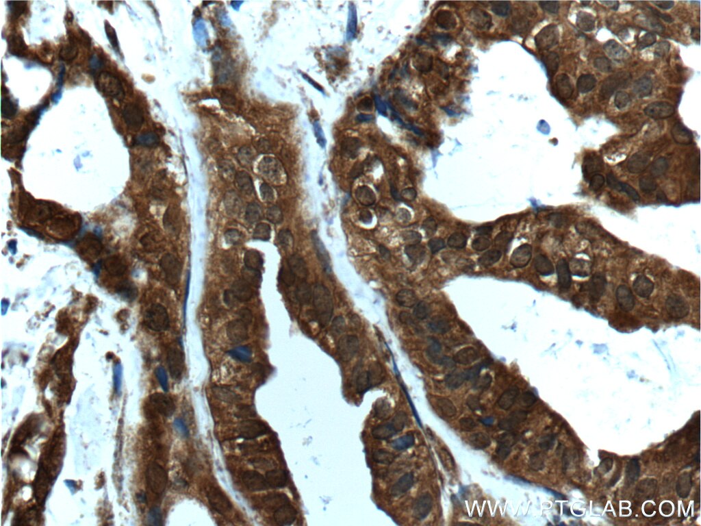 Immunohistochemistry (IHC) staining of human breast cancer tissue using AKT Polyclonal antibody (55230-1-AP)