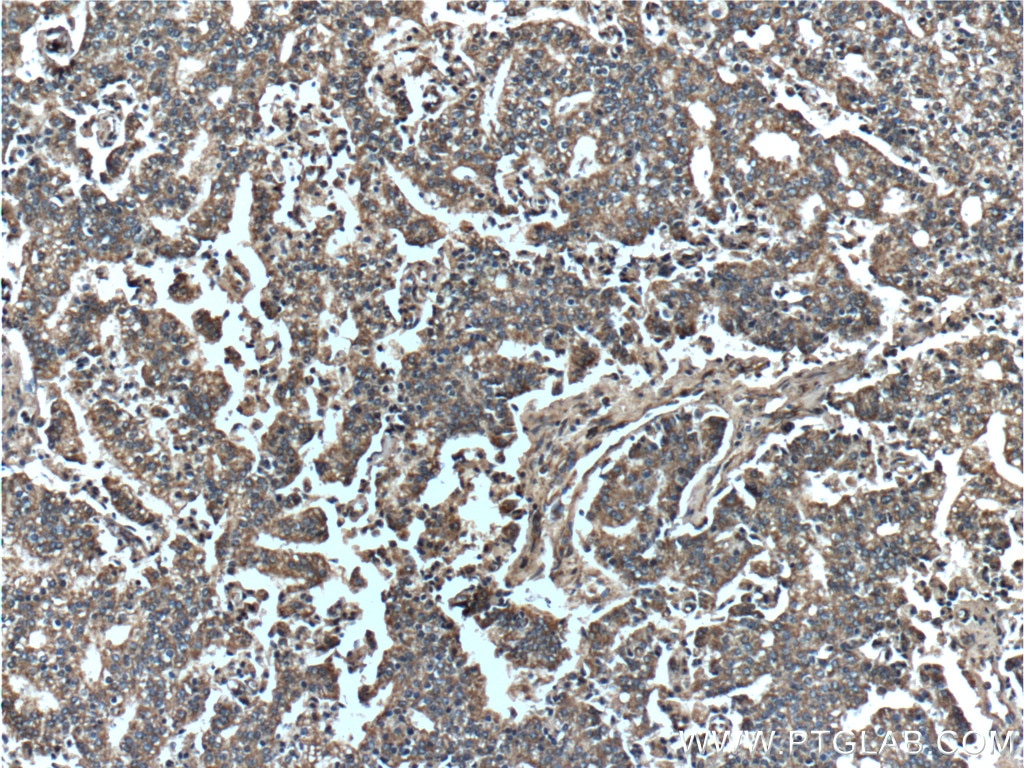 Immunohistochemistry (IHC) staining of human prostate cancer tissue using AKT Polyclonal antibody (55230-1-AP)