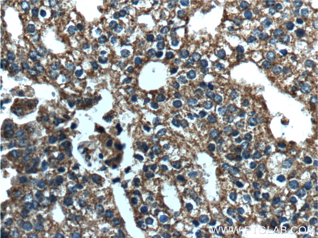 Immunohistochemistry (IHC) staining of human prostate cancer tissue using AKT Polyclonal antibody (55230-1-AP)