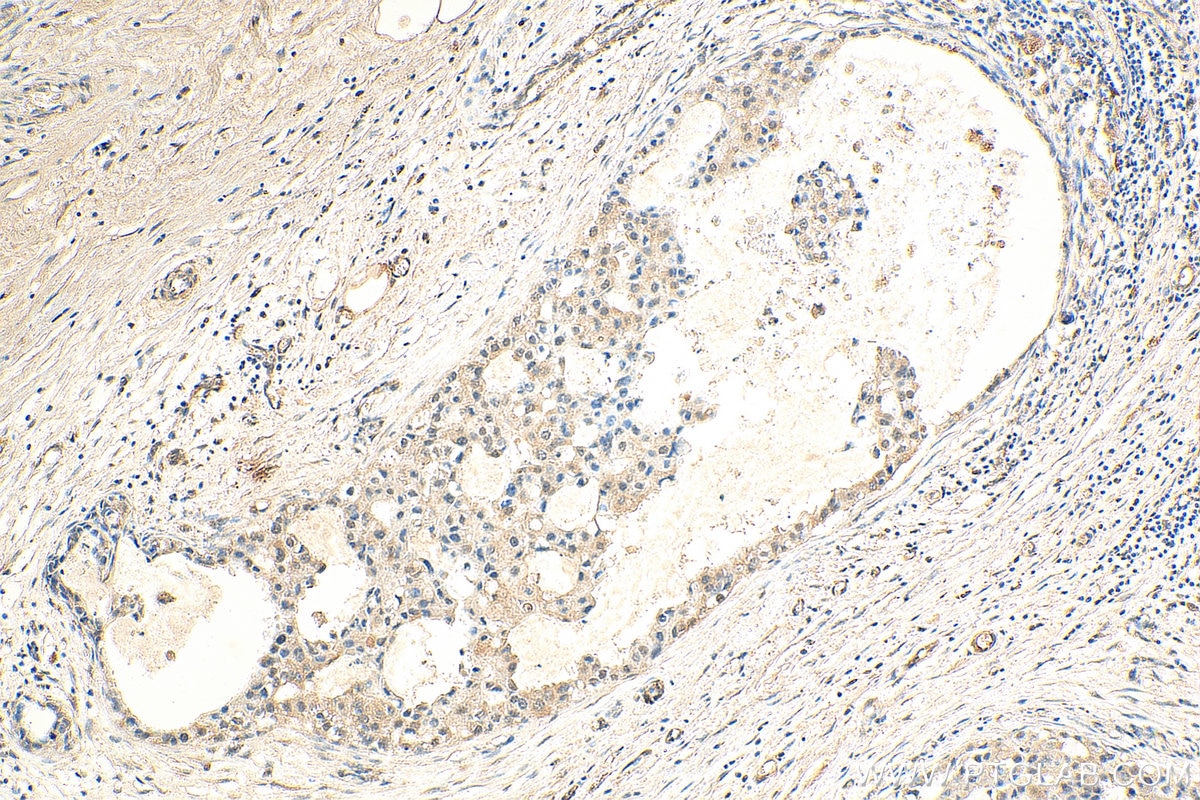 IHC staining of human breast cancer using 80457-1-RR