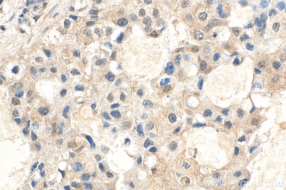 Immunohistochemistry (IHC) staining of human breast cancer tissue using AKT1 (C-terminal) Recombinant antibody (80457-1-RR)