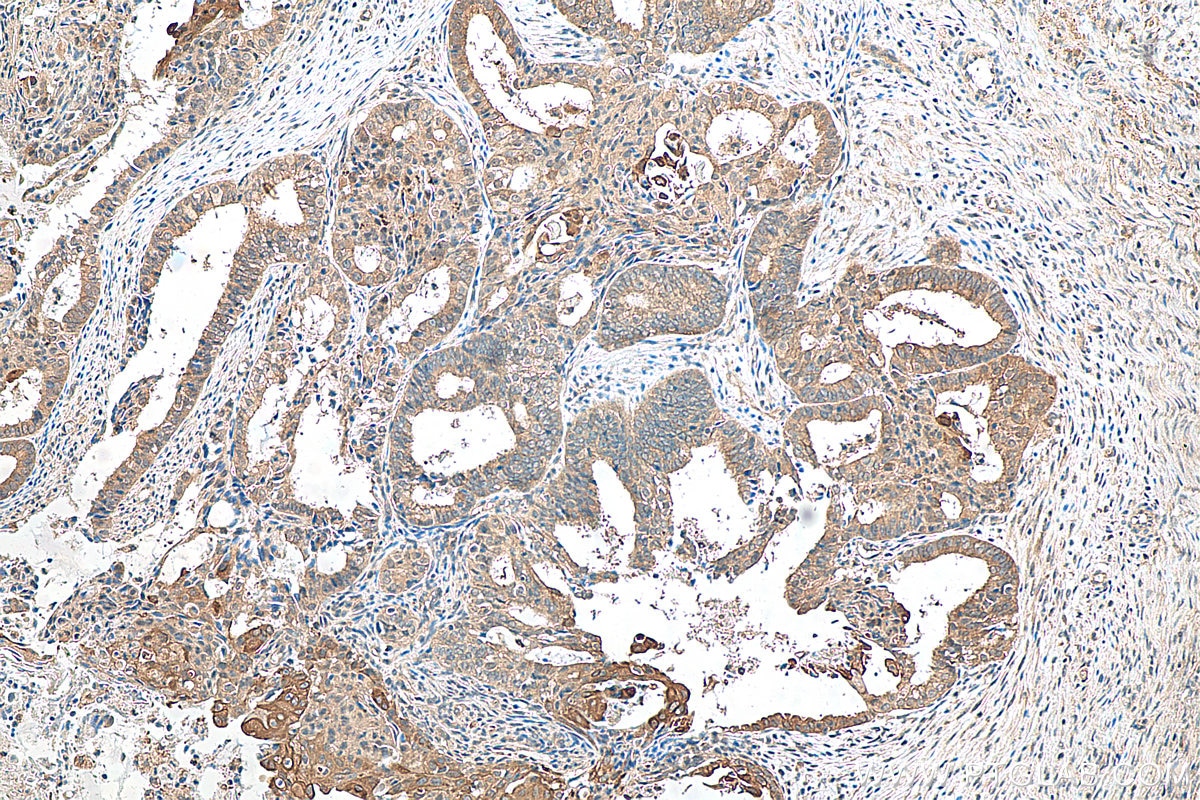 Immunohistochemistry (IHC) staining of human ovary tumor tissue using AKT1 Recombinant antibody (80816-1-RR)