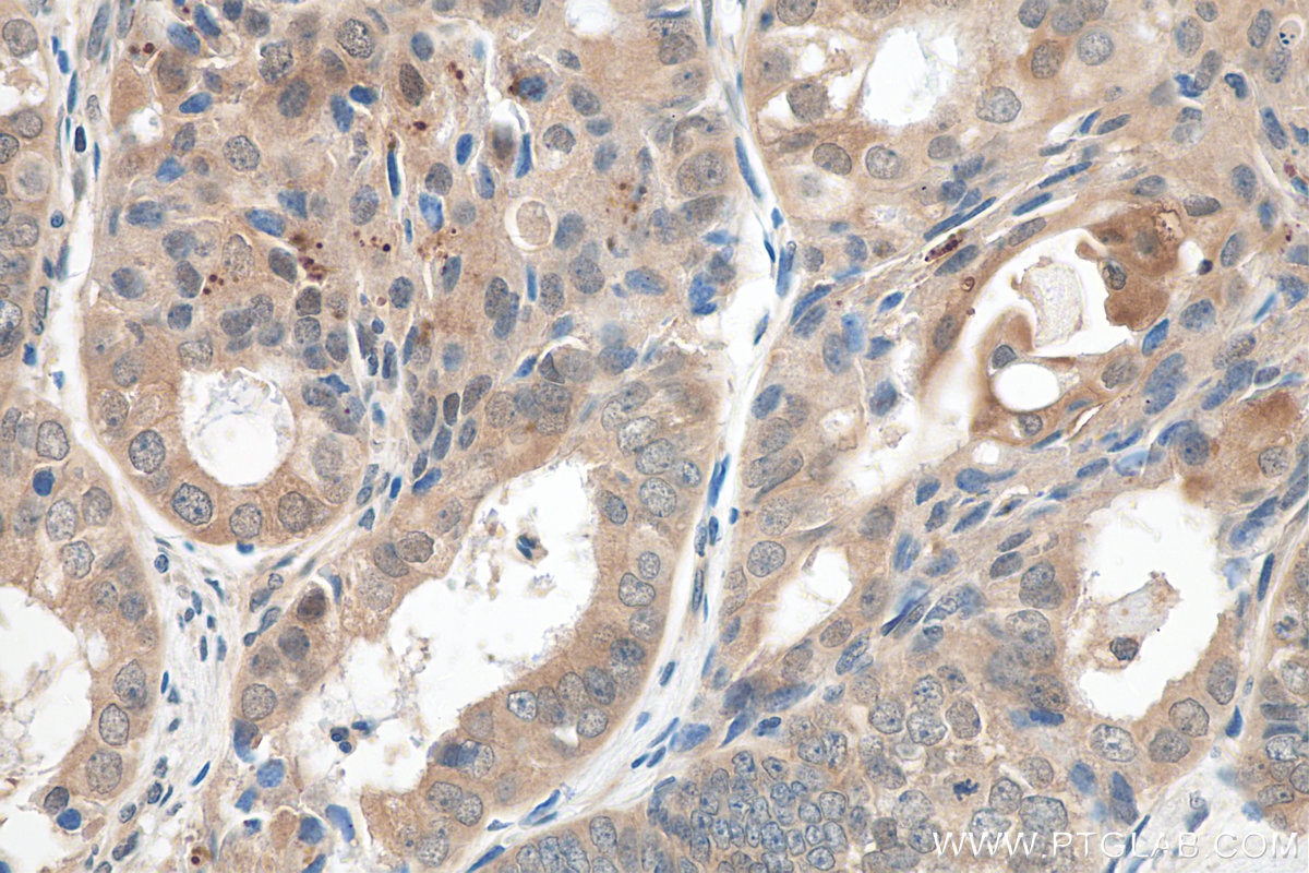 IHC staining of human ovary tumor using 80816-1-RR