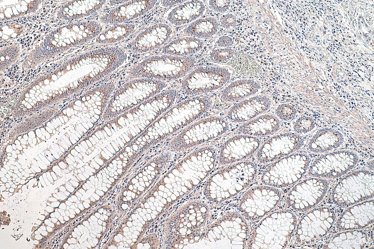 Immunohistochemistry (IHC) staining of human colon cancer tissue using Phospho-AKT (Ser473) Monoclonal antibody (66444-1-Ig)