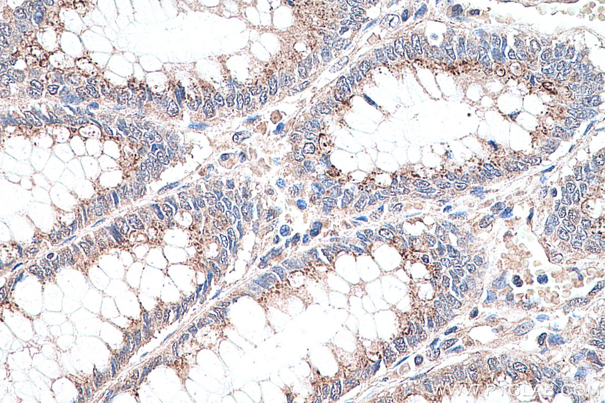 Immunohistochemistry (IHC) staining of human colon cancer tissue using Phospho-AKT (Ser473) Monoclonal antibody (66444-1-Ig)