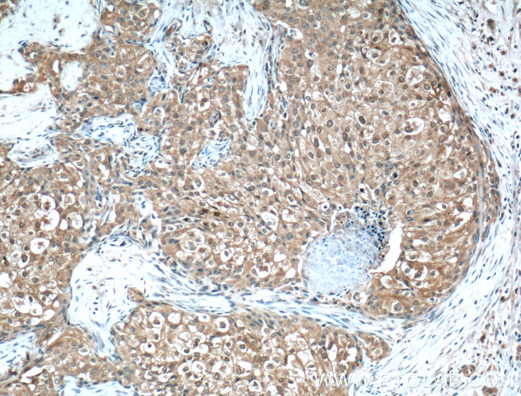 Immunohistochemistry (IHC) staining of human breast cancer tissue using Phospho-AKT (Ser473) Monoclonal antibody (66444-1-Ig)