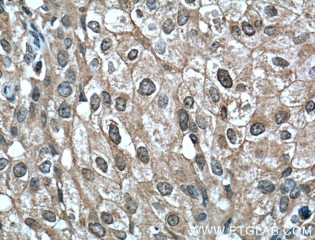 Immunohistochemistry (IHC) staining of human breast cancer tissue using Phospho-AKT (Ser473) Monoclonal antibody (66444-1-Ig)