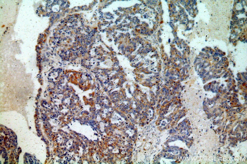 Immunohistochemistry (IHC) staining of human ovary tumor tissue using AKT2 Polyclonal antibody (17609-1-AP)