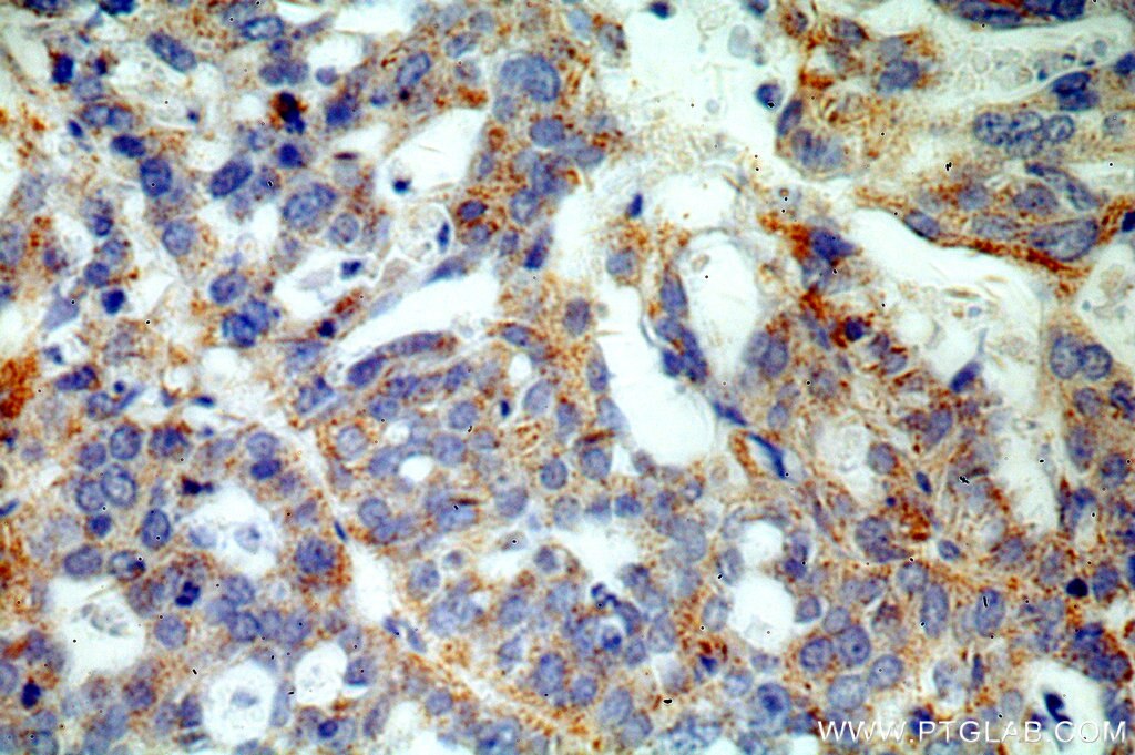 Immunohistochemistry (IHC) staining of human ovary tumor tissue using AKT2 Polyclonal antibody (17609-1-AP)