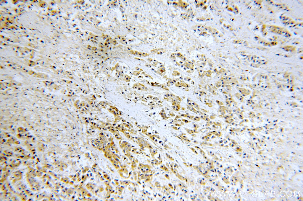 Immunohistochemistry (IHC) staining of human breast cancer tissue using AKT2 Polyclonal antibody (17609-1-AP)