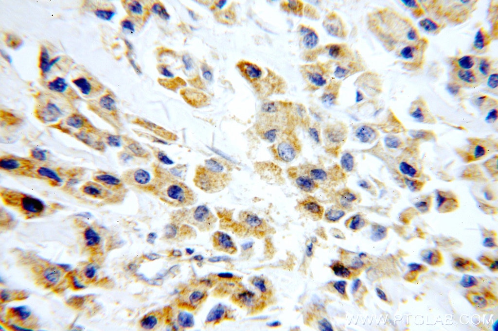 Immunohistochemistry (IHC) staining of human breast cancer tissue using AKT2 Polyclonal antibody (17609-1-AP)