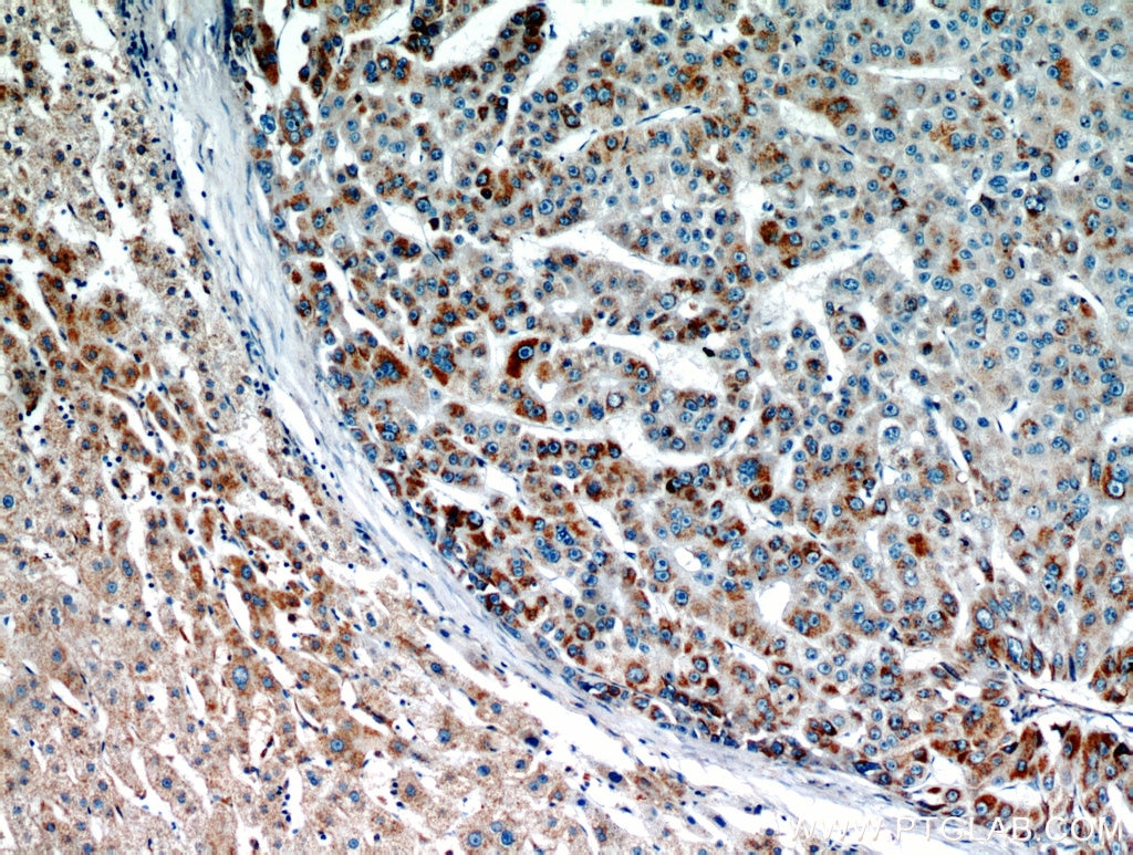 Immunohistochemistry (IHC) staining of human liver cancer tissue using AKT2 Polyclonal antibody (17609-1-AP)