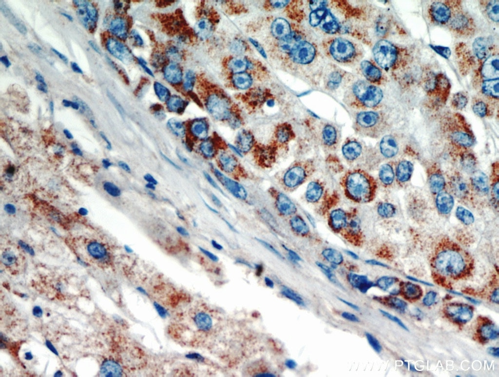 Immunohistochemistry (IHC) staining of human liver cancer tissue using AKT2 Polyclonal antibody (17609-1-AP)