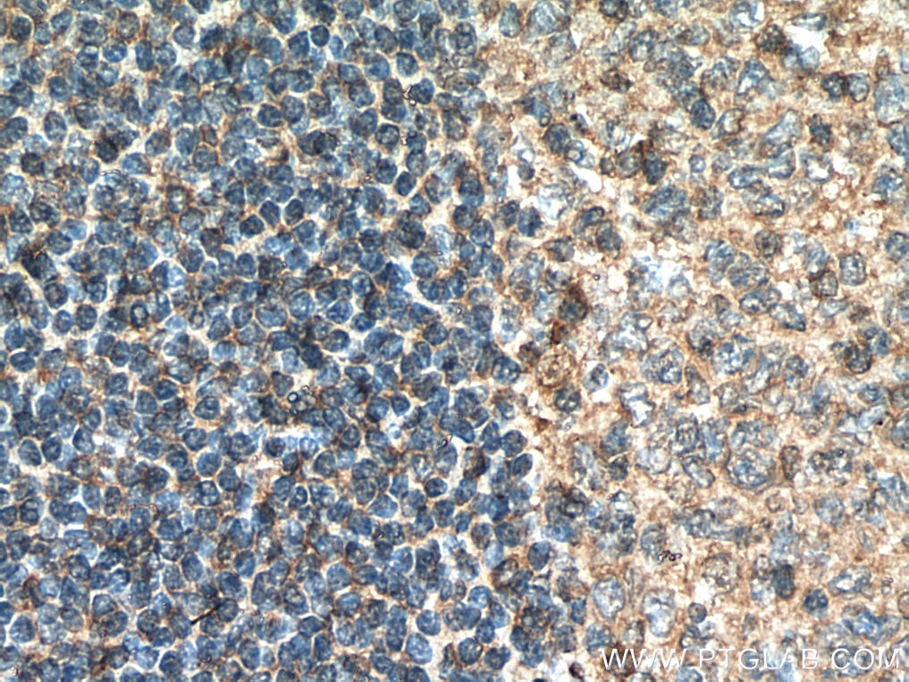 Immunohistochemistry (IHC) staining of human tonsillitis tissue using AKT3 Polyclonal antibody (21641-1-AP)