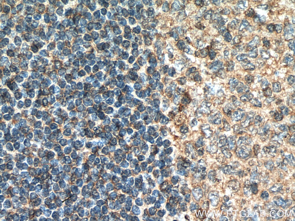 IHC staining of human tonsillitis using 21641-1-AP